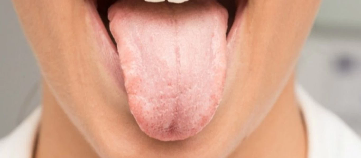 Καρκίνος στη γλώσσα: Πώς θα τον αναγνωρίσετε - Όλα τα σημάδια